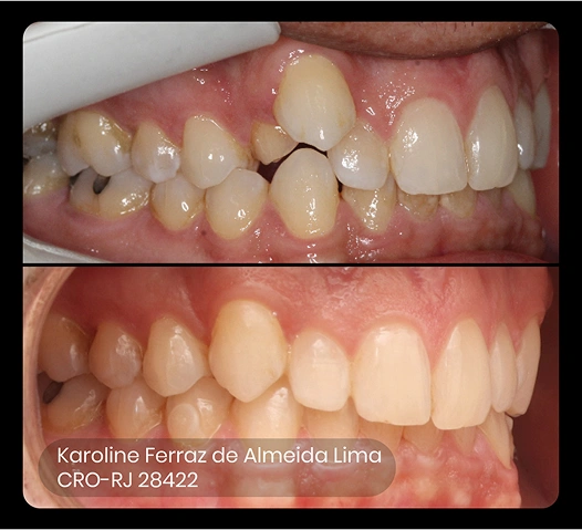 foto do antes e depois do tratamento ez 12