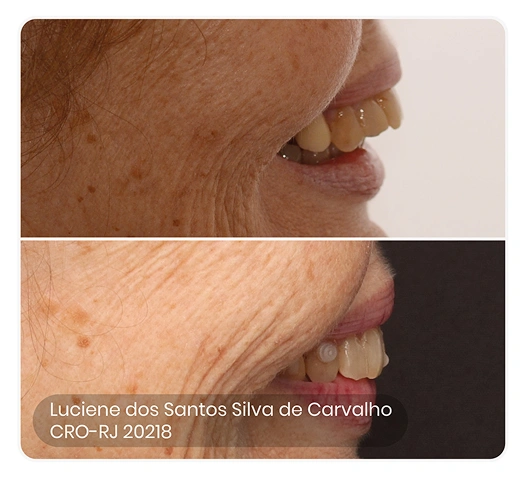 foto do antes e depois do tratamento ez 24
