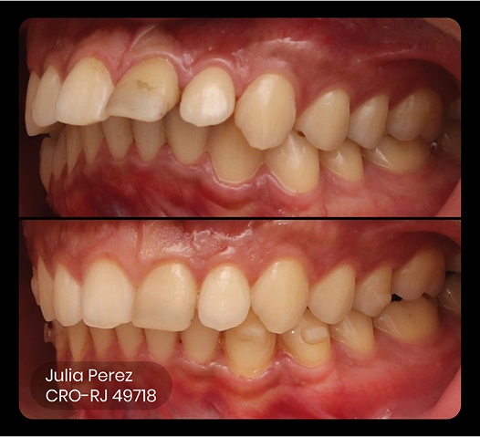foto do antes e depois do tratamento ez 24