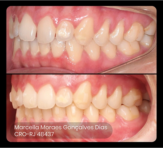 foto do antes e depois do tratamento ez 6
