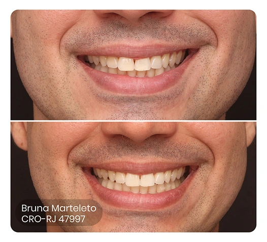 foto do antes e depois do tratamento ez flash
