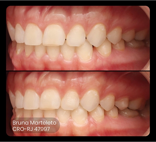 foto do antes e depois do tratamento ez flash