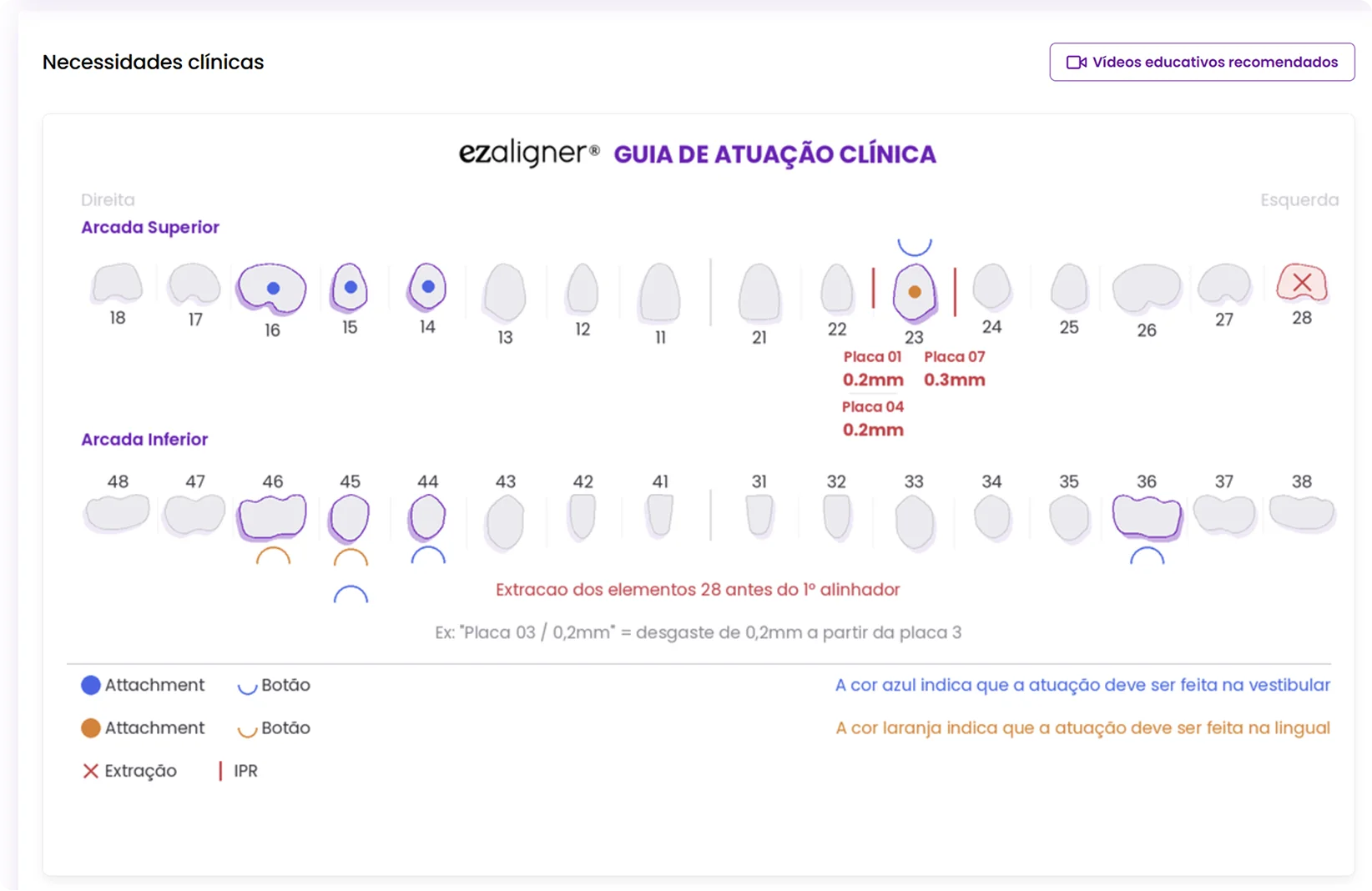 guia de atuação clínica ezaligner com arcada superior e inferior, attachments, botões e IPR