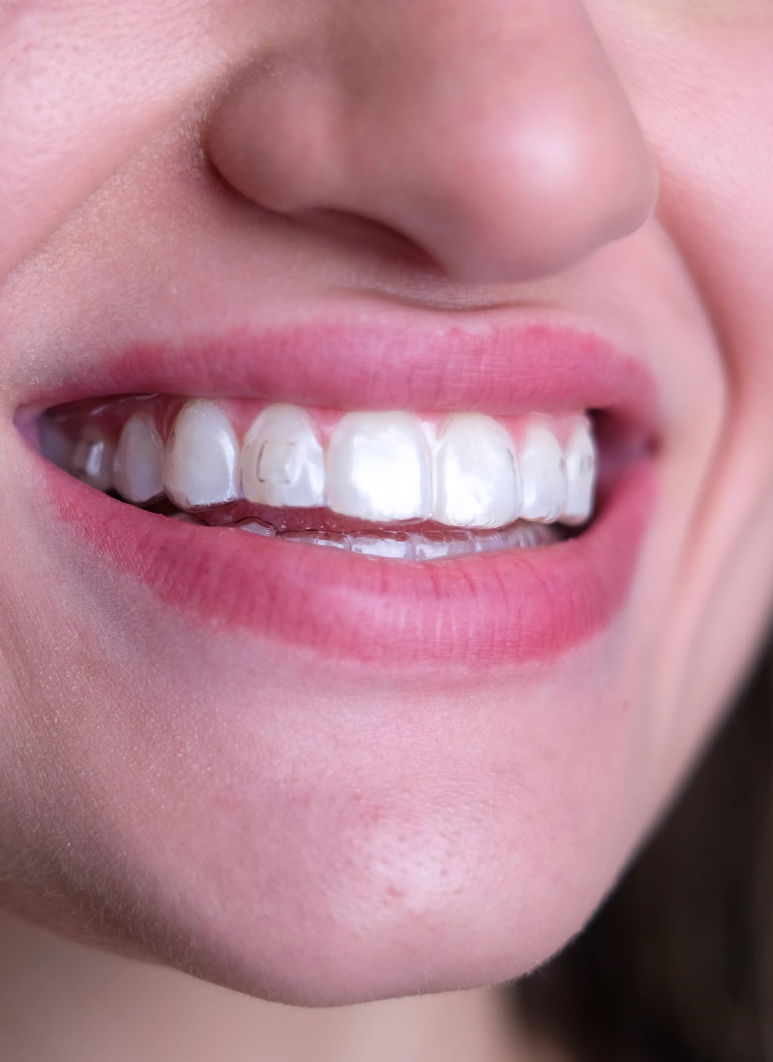 Close-up de sorriso com dentes alinhados e alinhador dental transparente em uso