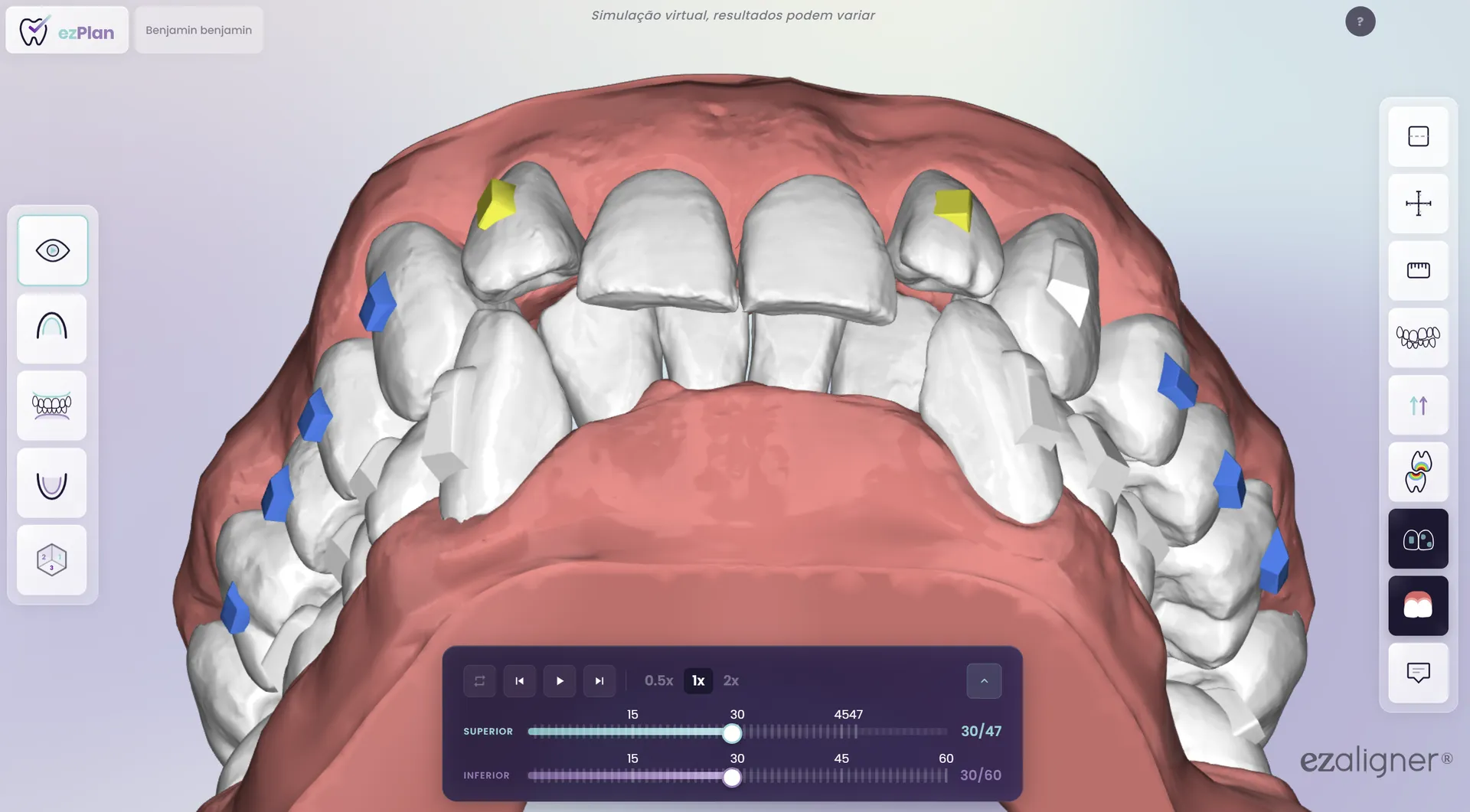 visualização 3D do ezplan com modelo dentário e attachments