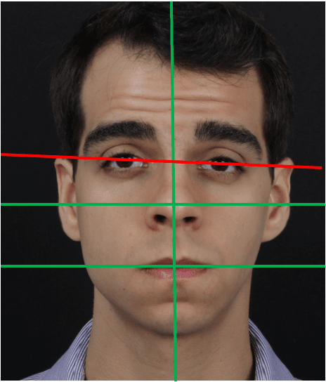 Nesses casos é preferível ignorar a linha bipupilar, e seguir a maior quantidade de referencias faciais que estão alinhadas em paralelo.