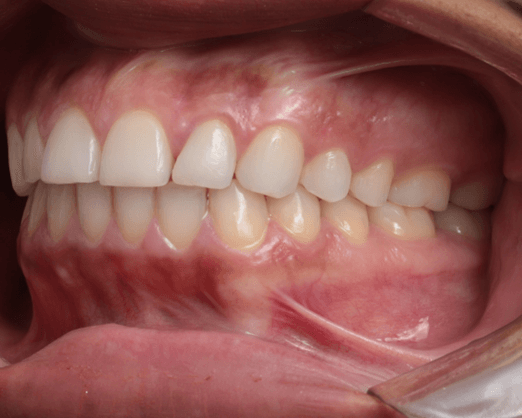 Intra-Oral Lateral Esquerda