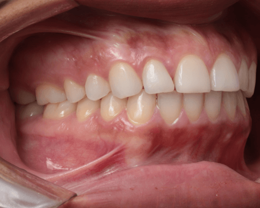 Intra-Oral Lateral Direita.