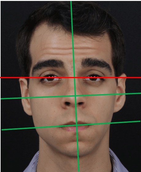 Desconfie de desvio de linha bipupilar, quando todos os planos da face estiverem desalinhado, principalmente a linha média. A linha média é o plano mais sacro da face.