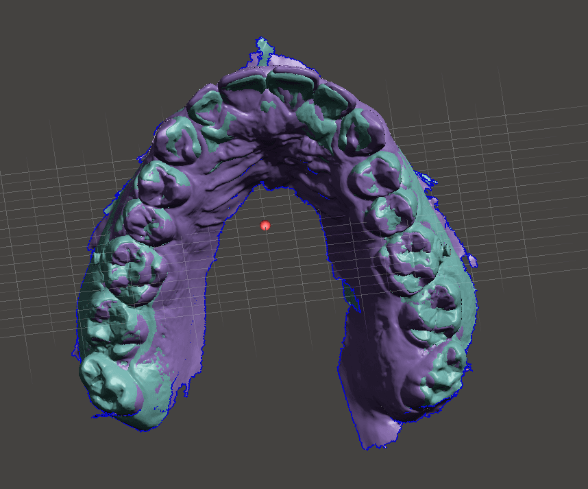 Sobreposição do escaneamento de diferentes fases de tratamento para acompanhar a evolução.