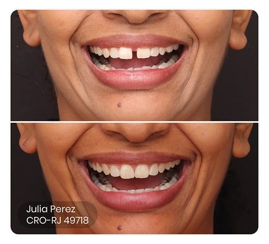 foto do antes e depois do tratamento ez 12