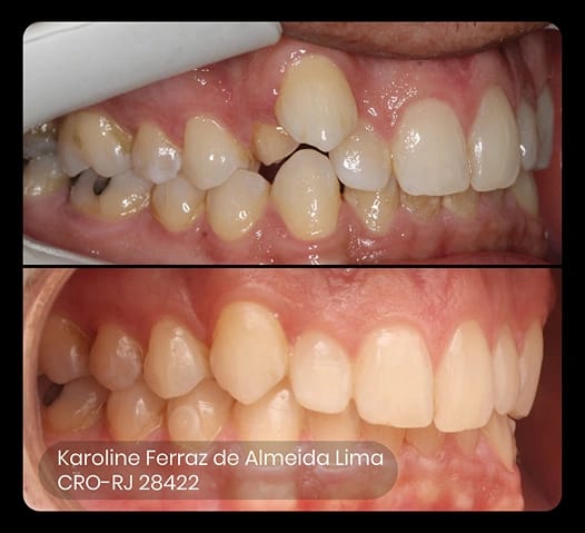 before and after photo of ez 12 treatment