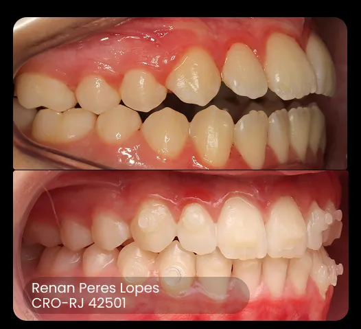foto do antes e depois do tratamento ez 18