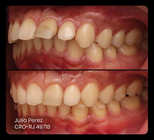 before and after photo of ez 24 treatment