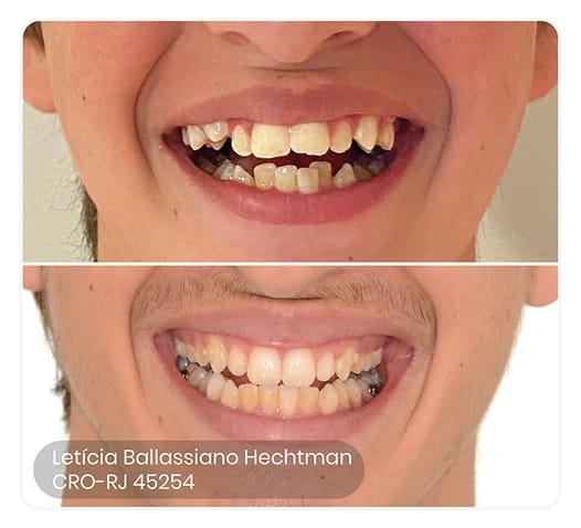 foto do antes e depois do tratamento ez 60