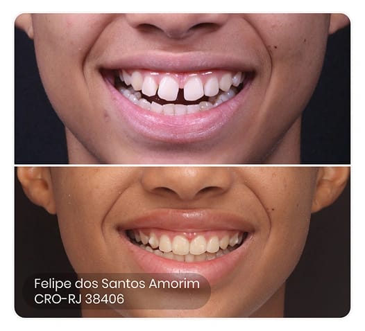 foto do antes e depois do tratamento ez 6