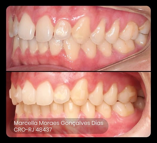 before and after photo of ez 6 treatment