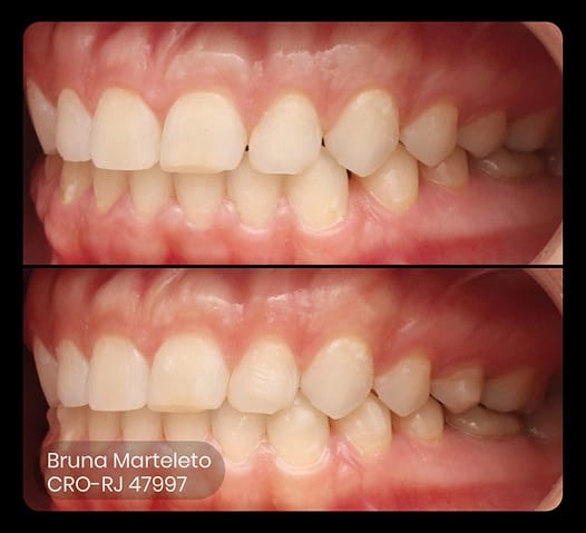 before and after photo of ez flash treatment