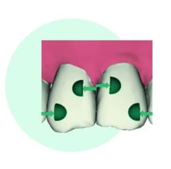 Attachments como rampas mecânicas: redirecionam forças e criam binários para controle radicular. Fonte: EON Aligner