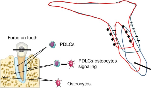 Lado de compressão (-) e lado de tensão (+) durante a movimentação dentária. Células do ligamento periodontal e osteócitos atuam como sensores mecânicos. Fonte: Int J Oral Sci (PMC, 2021)
