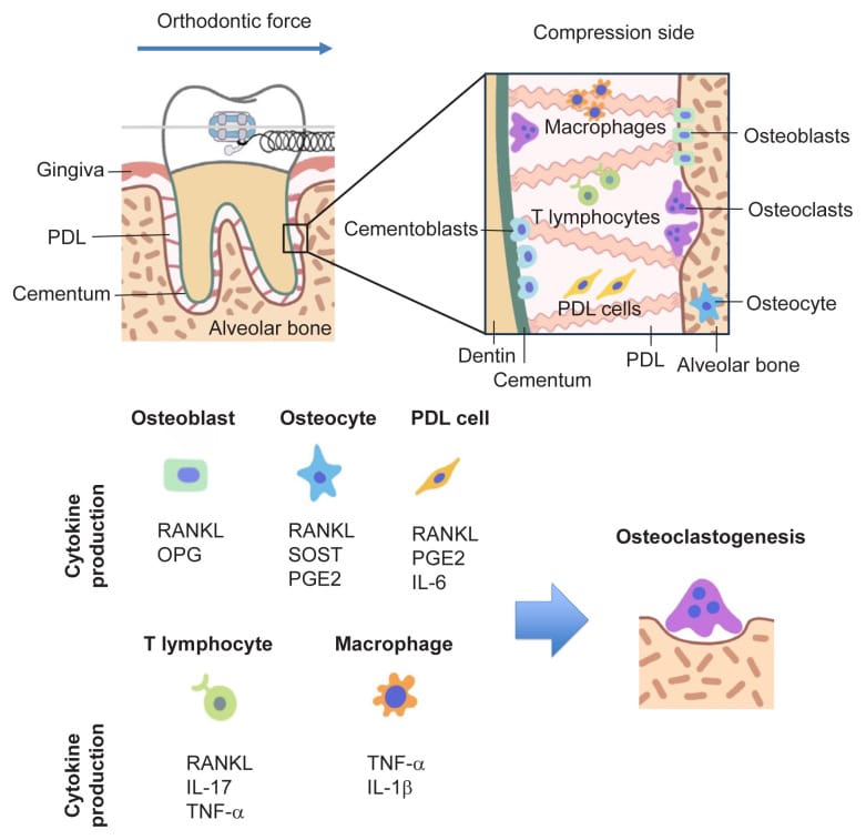 Esquema da osteoclastogênese durante a movimentação dentária: lado de compressão (reabsorção por osteoclastos) vs. lado de tensão (deposição por osteoblastos). Via RANKL/OPG. Fonte: J Bone Metab (PMC, 2023)