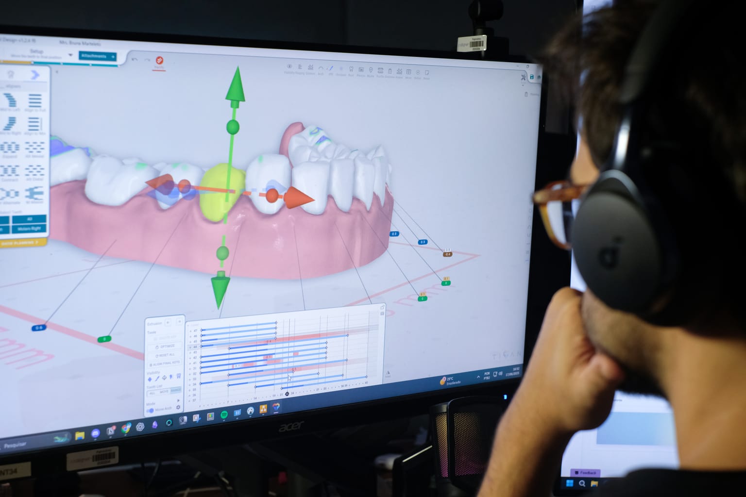 Planejamento digital dos alinhadores.